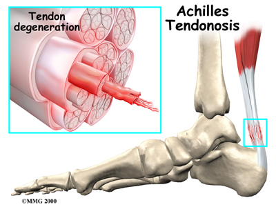 Shoe Repair Manhattan on Physical Therapy In Manhattan  Nyc For Achilles Pain